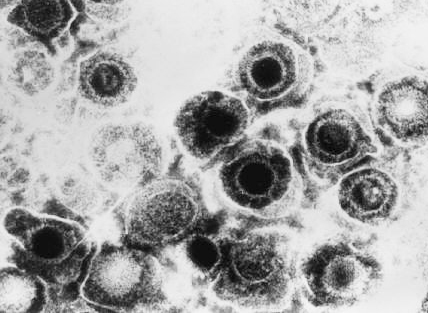 Herpes_simplex_virus.jpg